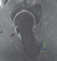 Radiographic Staging of Hip Osteoarthritis