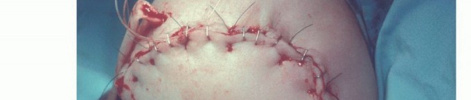 صورة طبية: بتر الذراع فوق وتحت الكوع: متى ولماذا يصبح ضرورة طبية؟ دليل شامل من الأستاذ الدكتور محمد هطيف