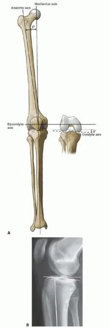 صورة توضيحية لـ جراحة استبدال مفصل الركبة الكلي بالأسمنت: حل دائم لتخفيف الألم واستعادة الحركة مع الأستاذ الدكتور محمد هطيف في صنعاء