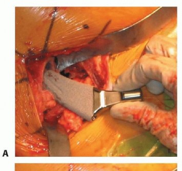 صورة طبية: نصف مفصل الورك: دليلك الشامل لدواعي الاستخدام والأنواع في صنعاء