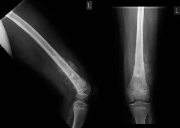 صورة توضيحية لـ ساركوما العظام: دليلك الشامل للتشخيص والعلاج والتعافي في صنعاء مع الأستاذ الدكتور محمد هطيف