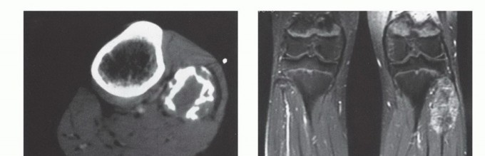 صورة لمريض يعاني من تورم في الساق