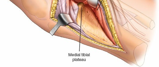 Figure 20: Radiograph demonstrating a malunion of a posterolateral tibial plateau fracture.