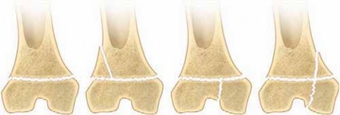 Understanding Physeal Fractures Distal: Prevent Growth Problems