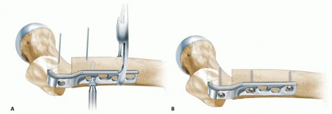 Illustration 15 for Proximal Femoral Osteotomy: When This Hip-Saving Surgery Is Performed