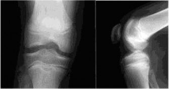Pediatric OCD: When to Consider Drilling for the Femoral