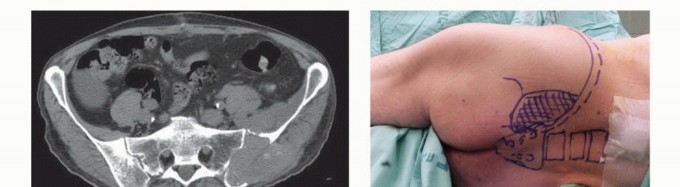 توضيح طبي: جراحة نقائل الحوض: حل شامل لآلام العظام واستعادة الحركة مع الأستاذ الدكتور محمد هطيف