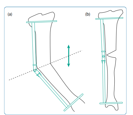 Illustration 5 for Limb Reconstruction: Restoring Function for Challenges Near and Far
