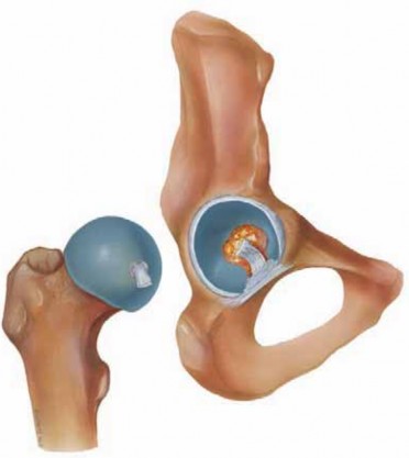 Solving Hip Soft Tissue Pathology with Advanced Arthroscopy