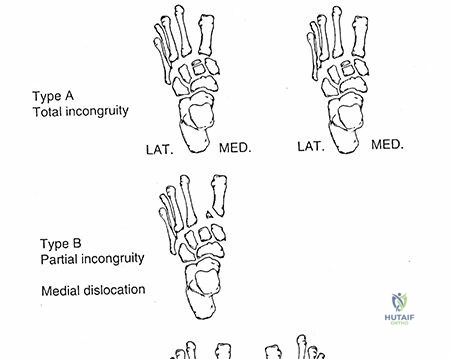 Operative Management of Patellar Fractures: A Comprehensive Surgical Guide