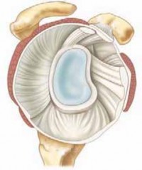 Find Relief from Shoulder DJD: Arthroscopic Débridement and Glenoidplasty