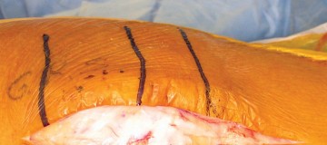 Illustration 7 for Minimize Pain, Maximize Recovery: TKA with Parapatellar