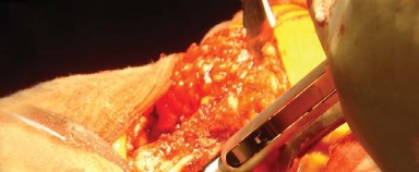 Illustration 20 for Posterolateral Surgical Approaches: Achieve Optimal Hip Replacement