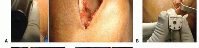 Illustration 6 for Unicondylar Knee Arthroplasty: Is This Your Solution to Knee Pain?