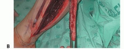 صورة طبية: ترقيع الشظية الوعائي الحر: حلول متقدمة لعيوب العظام المعقدة