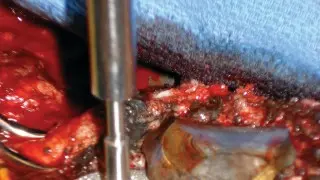 صورة توضيحية لـ إزالة الغرسات العظمية الثابتة بإحكام: دليل شامل لمرضى جراحة المفاصل الصناعية