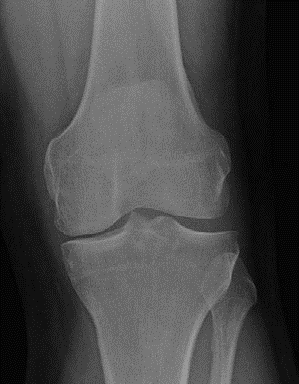 Illustration 2 for Oral Examination Question: Master Unicondylar UKA vs HTO