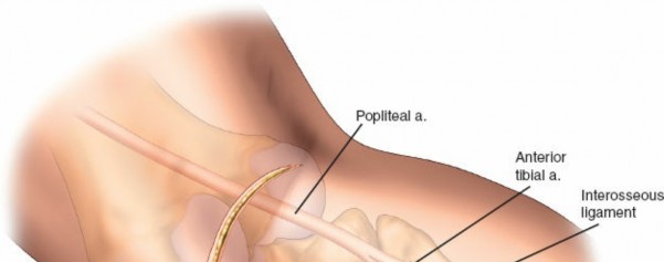 Figure 5: Pre-operative CT scan with 3D reconstruction showing a posterolateral tibial plateau fracture.