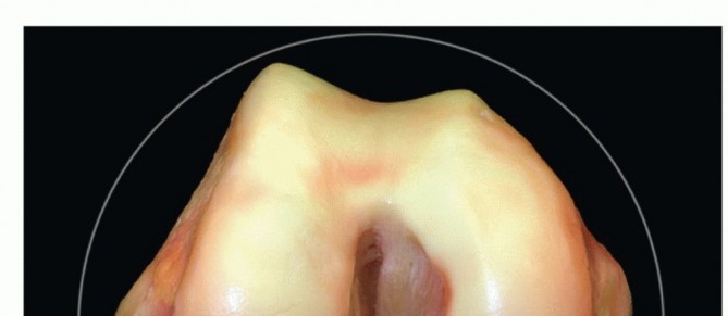 Double-Bundle ACL Reconstruction: Restoring True Knee Stability