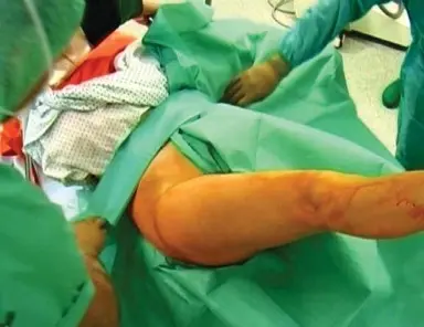 صورة توضيحية لـ النهج الأمامي الجانبي في استبدال مفصل الورك بالتدخل المحدود: دليل شامل للمرضى مع الأستاذ الدكتور محمد هطيف