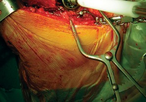 صورة طبية: طول عمر مكون الحُق الأسمنتي في مفصل الورك: مفتاح الاستقرار والديمومة مع الأستاذ الدكتور محمد هطيف في صنعاء