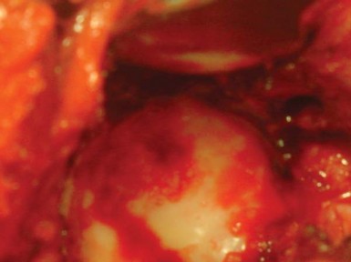 صورة طبية: استبدال مفصل الورك الكلي لالتهاب المفاصل الروماتويدي اليفعي: استعادة الحركة والأمل مع الأستاذ الدكتور محمد هطيف في صنعاء