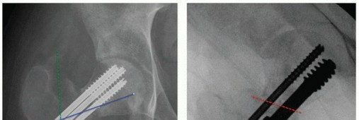 Illustration 27 for Periacetabular Osteotomy: Realigning your hip via the superior pubic ramus