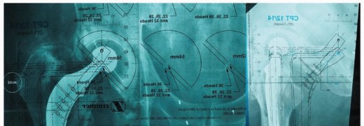 Cement in Cement Revision: Simplifying Complex Hip Revisions