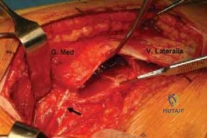 Contraindication Advanced Joint Space Narrowing