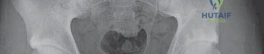 Anterior Retraction of the Digastric Flap
