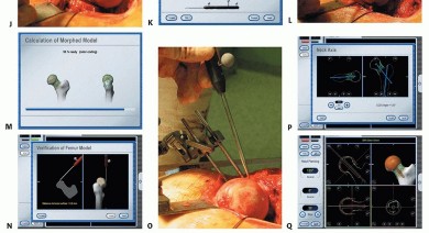 صورة طبية: ترميم مفصل الورك: الحل الأمثل للحفاظ على عظم رأس الفخذ في صنعاء مع الدكتور محمد هطيف