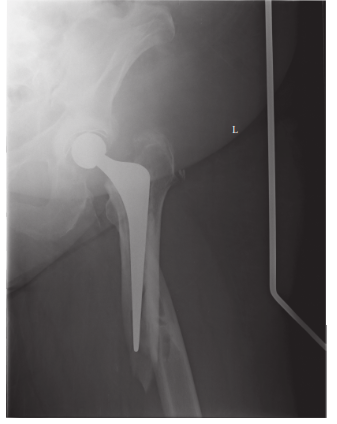 Illustration of periprosthetic fracture periprosthetic - Dr. Mohammed Hutaif