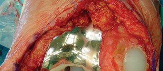 Illustration 33 for Revision of Failed UKA: Your Guide to Successful Treatment