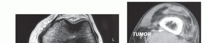 Complex Popliteal Resections: Protecting the Greater Saphenous Vein