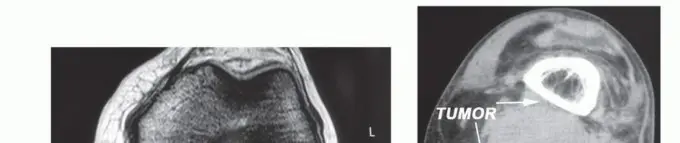 صورة توضيحية لـ استئصال الأورام المعقدة في الحفرة المأبضية وحماية الوريد الصافن الكبير: دليل شامل للمرضى مع الأستاذ الدكتور محمد هطيف