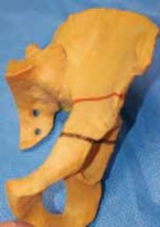 Hip Dysplasia: Inner & Outer Acetabular Reshaping with Pemberton & Dega