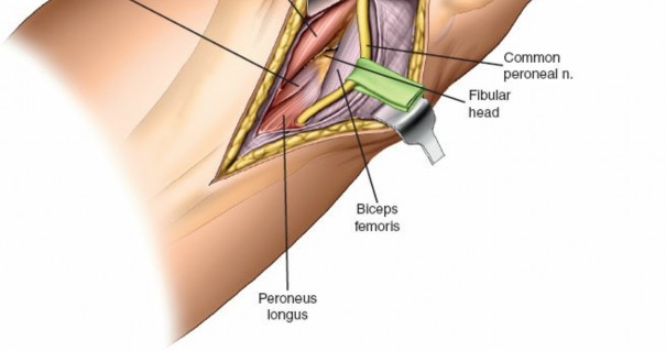 Figure 4: Diagram illustrating the specific area of bone exposed by the posterolateral approach, often necessitating a buttress plate.