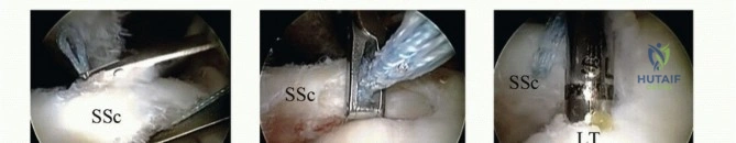 Illustration of treatment of subscapularis tears - Dr. Mohammed Hutaif