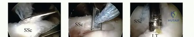 Overlooked Tears? Advanced Treatment of Subscapularis Tears