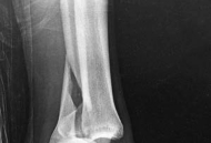 Illustration 2 for Partial Articular Fractureplate Fixation: Restore Anatomy