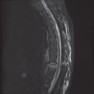 Illustration 14 for Spondylodiscitis: Deciphering the next course of action