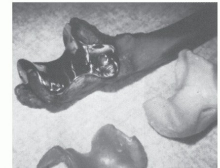 Elbow Arthroplasty's Journey: From History to Current Designs