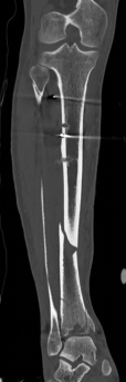 Illustration 5 for Complex Tibial Shaft Fracture: Plate Fixation for Plafond Extension