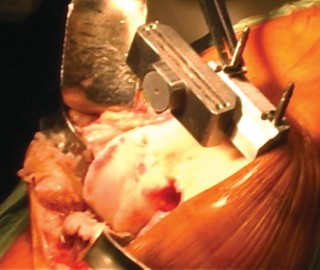 Illustration 10 for Cemented TKA Figure: Your Visual Guide to Surgical Success