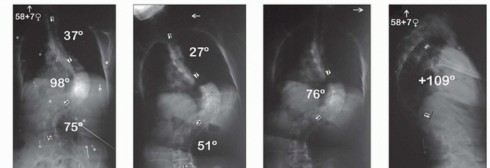 Illustration of column resection for severe - Dr. Mohammed Hutaif