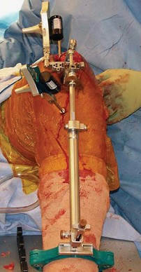 Illustration 25 for Optimize Tibial Component Alignment: Techniques for TKA Success