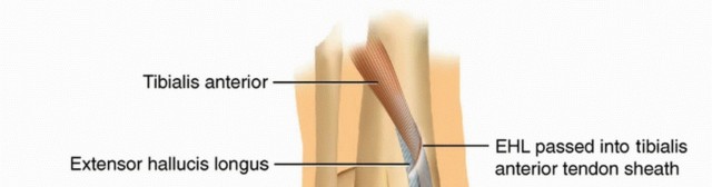 Illustration of tibialis anterior rupture - Dr. Mohammed Hutaif