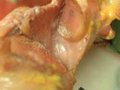 Regain Stability: Anterior Shoulder Instability Arthroscopic Fix