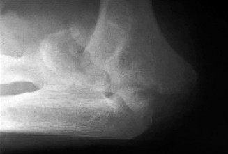 Posttraumatic Elbow Arthritis: Best Management for Young Adults