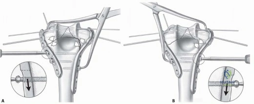 Illustration 11 for Optimizing ORIF for Distal Humerus: Prevent Class II HO